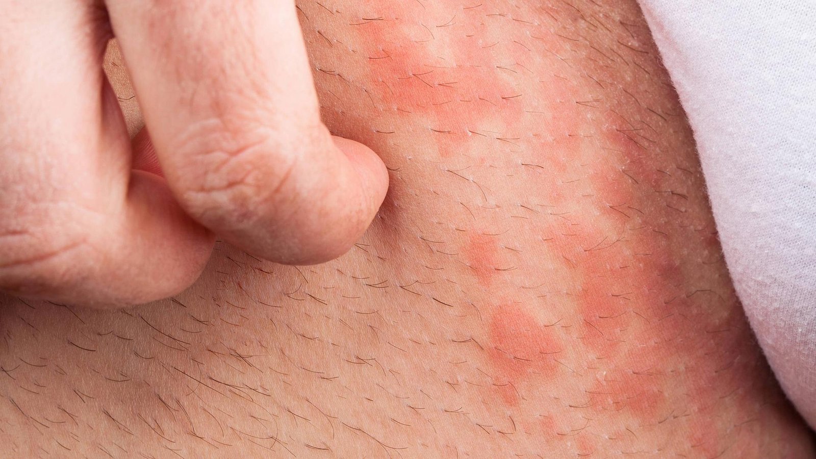 milben hautausschlag fotos